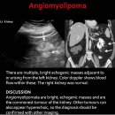 Angiomyolipoma 이미지