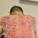 평촌의료기 | 혈액을 맑게 하는 관리는 혼자는 어렵다! 바른 식습관,운동도 하고,병원검진에서도 이상없는데 멍이 잘...