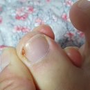 어반페이머스신용화점 | 아산 용화동 네일 '내성발톱 교정 잘하는 곳' : 어반페이머스 네일 신용화점