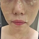 러버블리 | 안양,범계 주근깨제거 받고옴 내돈내산후기 (첫날~2주차까지)