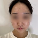 청담동 피부관리 비알부티크 청담 고급 비올로직호쉐쉬 표피재건 관리 후기