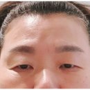 중년눈성형 상안검 후기예요. 효도성형 찾는 분들은 꼭 보세요~!