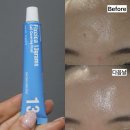 제일건강한약국 | 픽시카겔 약국 가격 내돈내산, 이마 뾰루지에 써본 바르는 패치겔 후기(before/after)