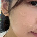 동성로 편사 성지 편평사마귀 제거치료 후 완전히 아물기까지 후기
