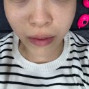 창원피부과 상남동피부과 피코토닝 후기