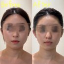 대박 | 신림윤곽관리 아늑 에스테틱&amp;헤드스파｜비대칭관리 비포애프터 대박 후기