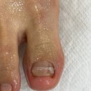 레푸스인하대역점 내성발톱 무좀발톱 발각질 문제성발 이미지