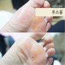 부산문제성발관리 푸스올 서면점에서 티눈 관리 / 푸스플레게교육