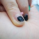 손톱 큐티클 가시래기, 손끝 손가락 엄지발톱 새끼발톱 갈라짐 해결