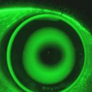 연세맑은안과의원 | 개롱역 안과 드림렌즈 착용시기 '이때'가 적기입니다