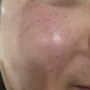 멘토의원 | 루비레이저 후기 2주차 부터 2년차 후기까지 멘토의원