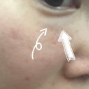 (주)우전브이티 | 눈밑지레이저 200샷 눈밑지방재배치 압구정피부과 후기