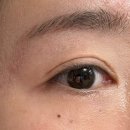 관상학 | 왼쪽 눈밑 + 귓볼 미인점 시술 후기 |관상학적 재물복,이성운 의미 총정리