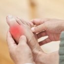 완치가 어려운 고질병 &#39;통풍&#39; 이미지