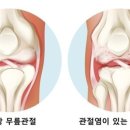 Arthritis 관절염 이미지