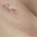 연세팜약국 | 30세 쉬었음 청년의 개뜬금 대상포진 발병기 (사진有)