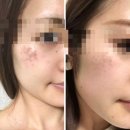 플라즈마 레이저 부작용 관리 리얼 후기