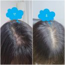 쿨캐치 | 탈모, 두피 기름지면 쿨캐치 마사지기로 두피열내리기