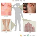 건선특정치료비(급여, 연간1회한)보장 특별 약관[무배당 내Mom같은 베이비보험2304] 이미지