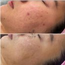 더희에스테틱 | [광주 첨단 피부] 연예인 필링 물광필 물톡스 찐후기 / 유앤희에스테틱 피부 전후 후기