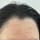 에이원헤어라인 이미지