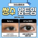 쌍수 앞트임 붓기가 안빠진다면 이렇게 해보세요 이미지