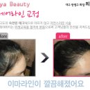 핑크헤어라인 이미지