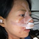 콧대높은 개 | [내돈내산] 오브제 성형외과 / 이경묵 원장님한테 메부리코 수술 받은 후기