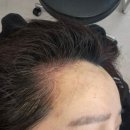 (주)에디뷰티코리아 | [서울] 강남헤어라인 저통증 자연스러운 양재 두피커버 "에디뷰티"
