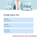 하지웰심장혈관흉부외과의원 | 발등이 붓는 사람 vs 발목이 붓는 사람, 종아리가 붓는 사람