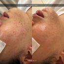 수원 남자 피부관리, 남자답게 무시했다간 진짜 평생가요!