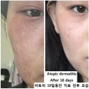 아기피부 대체 왜이런걸까요.병원에서 보습신경쓰래서 제로이드처방받아 한달에 한통씩 쓸정도로 많이...