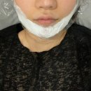 프라임 | 청담피부과 울쎄라프라임 내돈내산 후기 | 위치•통증•전후