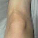 7492 | 강남흉터관리, 비비스카랩 방문 내돈내산 솔직후기.