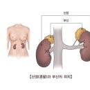 신부전 (Renal failure) 이미지
