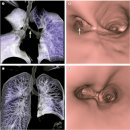 흉부 견축2 chest retraction 이미지