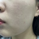 조한약국 | 여드름약 이소티논 로아큐탄 복용기간 부작용 해결법