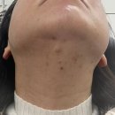 하리오네일 | 대전웨딩관리 설브봉명본점 성인여드름케어 후기