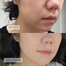 대구 올타이트리프팅 후기｜시술 전후 효과 이렇게 달라졌어요