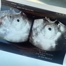 쌍둥이추어탕 | 평촌마리아 시험관 2차 성공후기 | 동결 1차 이식 5일 배양 후기 | 시험관 성공 비법