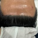 두피문신제거 헤어라인제거 찾으세요? 이글 안보면 후회합니다.