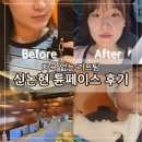 페이스 | 신논현피부과 튠페이스 60kj 후기
