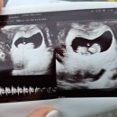 안동중앙산부인과의원 | [임신 10주 1일] 초음파 기록, 안동중앙산부인과의원, 장거리비행 전 아기 컨디션 체크