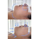 로다샵 | 대구 봉무동 뷰티로다본점 로다에스테틱 : 통증 없는 리프팅관리로 추천! 싸이블로 리프팅 관리 솔직후기