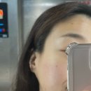 포프로짐 | 비박피성 레이저 패키지 절반 후기｜미라젯 프락스프로 시술 후 일주일 피부 변화