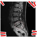 단골병원 | 단골병원 척추 협착증 후기