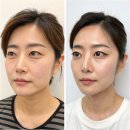 바리스타A (3개월 과정) | 쌍커풀 수술 붓기, 붓기약, 빠지는 과정, 부작용, 3개월차 후기