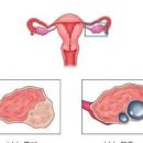 왼쪽 아랫배 통증 원인여자남자 이미지