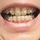 참바른치과교정과치과의원 | 치아 교정 기록- 비발치/클리피씨/악궁확장장치/1년 7개월째 진행중/광주 교정치과 추천