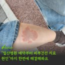 스마일분당예치과병원 | 국민건강 일산병원 예약하고 피부건선 원인 찾으러 다녀온 솔직후기